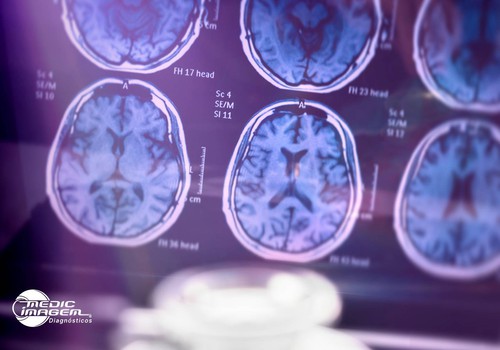 Fevereiro Roxo: a importância dos exames de imagem na luta contra doenças neurológicas