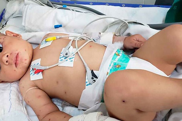 Bebê de seis meses picado por escorpião em Patos de Minas é levado às pressas para BH