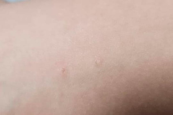 Garoto de 9 anos é mordido por morcego enquanto tomava banho em Patos de Minas