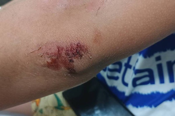 Adolescente de 12 anos é atropelado no bairro Ipenama; motorista disse que buscaria documentos e fugiu
