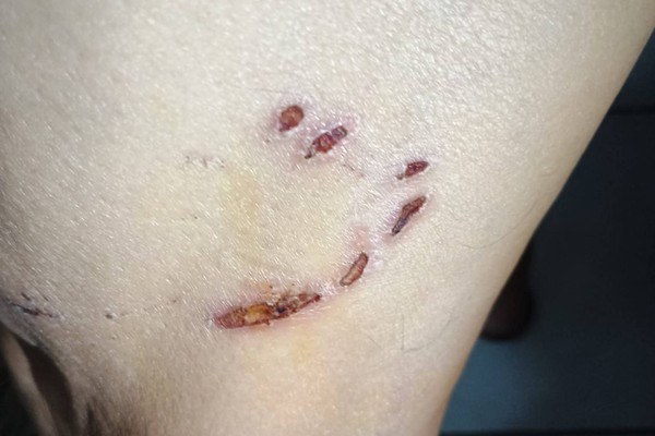 Idoso é atacado por 3 cães durante caminhada em Patos de Minas e caso acende alerta sobre animais soltos nas ruas