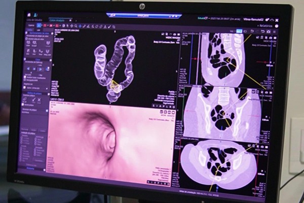 Setembro verde: como a prevenção do câncer de intestino e a colonoscopia convencional e a digital podem salvar vidas