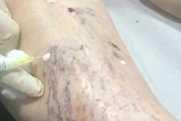 Angiologista volta a tratar varizes em Patos de Minas e mostra em vídeo eficácia do procedimento