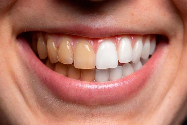 Clareador de Dentes: Onde comprar o Melhor do Brasil? - DentalBianco