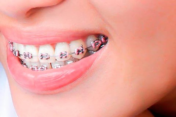 Campanha “Livre para sorrir” oferece vagas para aparelho dental em Patos de Minas