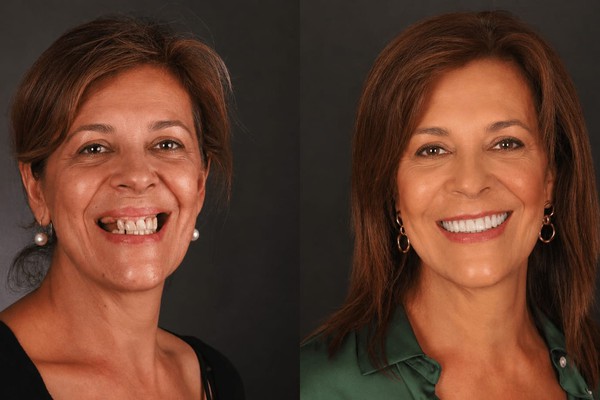 Dentista realiza transformação de vida para quem usa próteses; assista o vídeo!