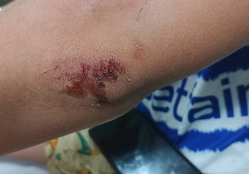 Adolescente de 12 anos é atropelado no bairro Ipenama; motorista disse que buscaria documentos e fugiu