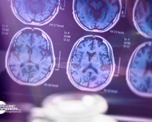 Fevereiro Roxo: a importância dos exames de imagem na luta contra doenças neurológicas