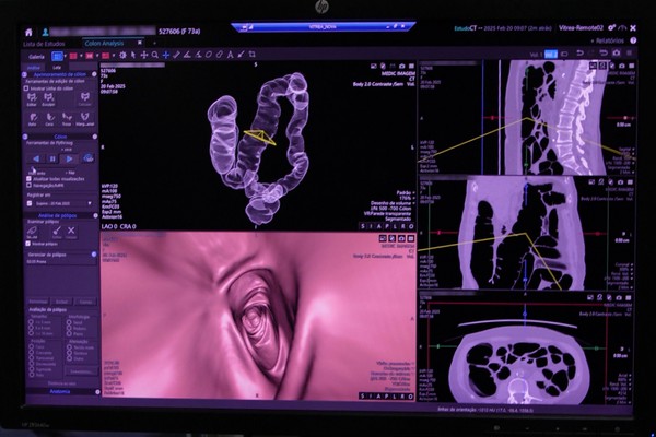 Maio Roxo alerta para aumento de 15% ao ano em doenças inflamatórias intestinais no Brasil