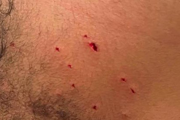 Jovem com tornozeleira eletrônica se auto lesiona após agredir a namorada, mas acaba preso em Patos de Minas