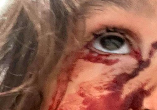 Garota de 4 anos é atacada por cão de rua enquanto brincava dentro de condomínio em Patos de Minas