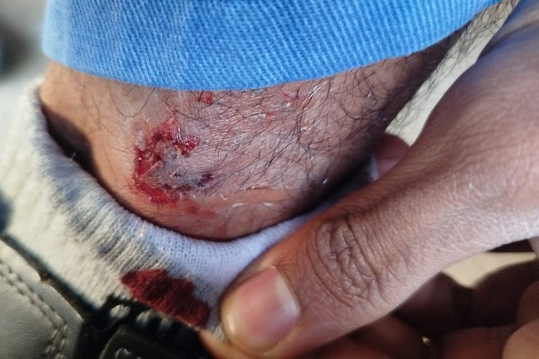 Moradores do Alto da Serra se revoltam com constantes ataques de cães e cobram providências