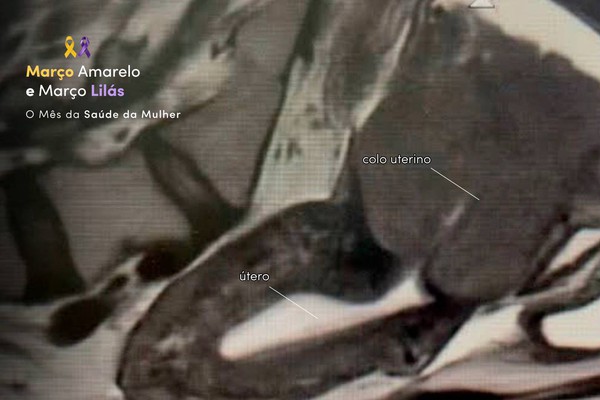 Março Lilás e Amarelo: campanhas de conscientização para o diagnóstico precoce do câncer de Colo de útero e endometriose