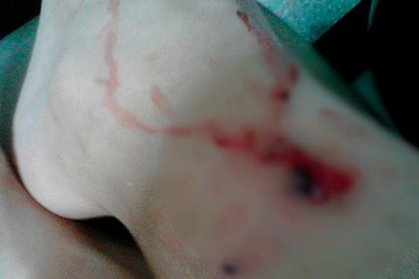 Cão morde perna de criança em mais um ataque de animal abandonado em Patos de Minas