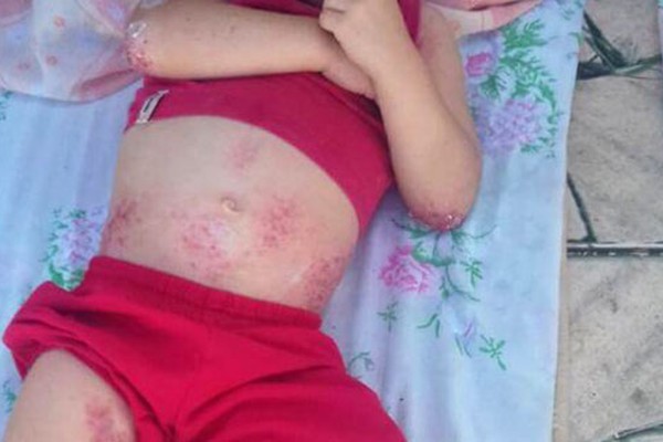 Família pede ajuda para garotinho de 3 anos que sofre com alergias pelo corpo em Lagoa Formosa