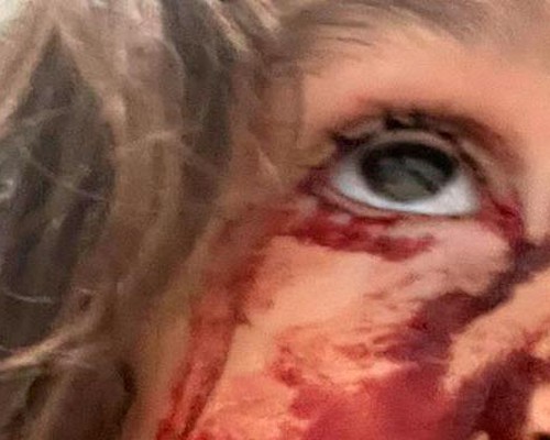 Garota de 4 anos é atacada por cão de rua enquanto brincava dentro de condomínio em Patos de Minas