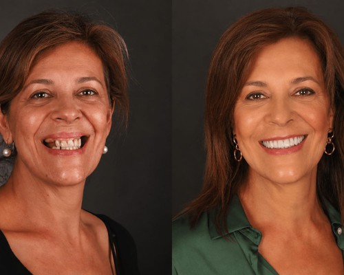 Dentista realiza transformação de vida para quem usa próteses; assista o vídeo!
