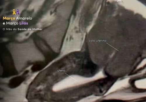 Março Lilás e Amarelo: campanhas de conscientização para o diagnóstico precoce do câncer de Colo de útero e endometriose