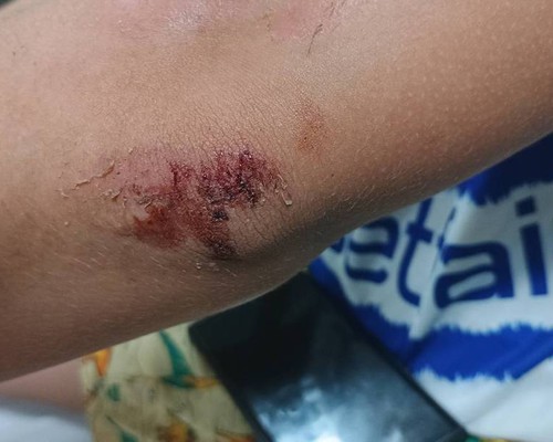 Adolescente de 12 anos é atropelado no bairro Ipenama; motorista disse que buscaria documentos e fugiu