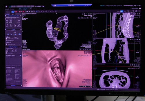 Maio Roxo alerta para aumento de 15% ao ano em doenças inflamatórias intestinais no Brasil