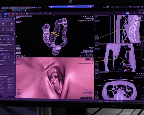 Maio Roxo alerta para aumento de 15% ao ano em doenças inflamatórias intestinais no Brasil
