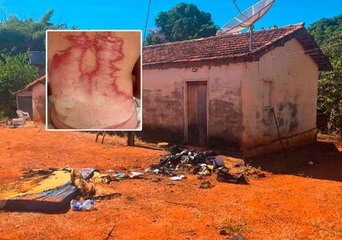 PC investiga incidente que deixou jovem com graves queimaduras por todo o corpo, em Retiro da Roça