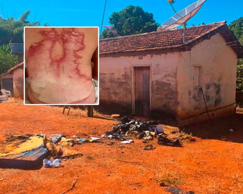 Jovem que jogou gasolina e ateou fogo no amigo é indiciado por homicídio tentado triplamente qualificado
