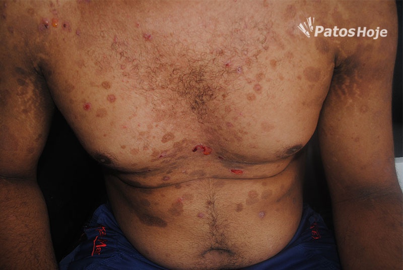 Jovem com “fogo selvagem” conta história dramática e pede ajuda da população patense