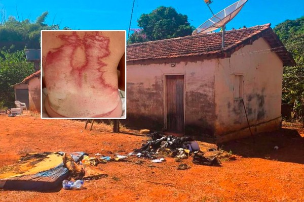 Jovem que jogou gasolina e ateou fogo no amigo é indiciado por homicídio tentado triplamente qualificado